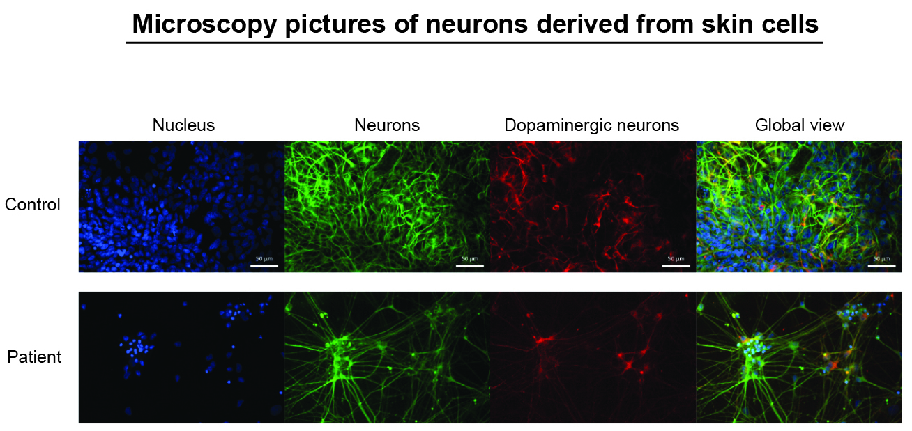 Microscopy pictures of neurones derived from skin cells