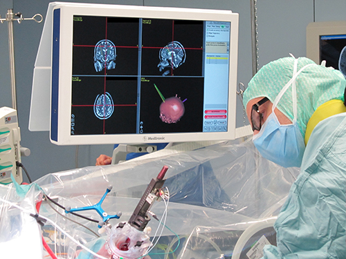 Tiefen Hirnstimulation